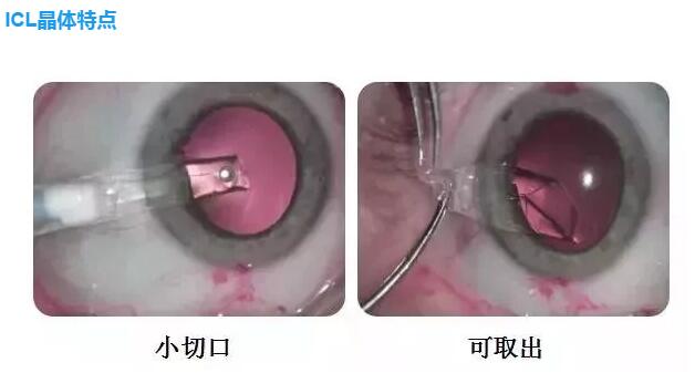 ICLֲձӦʹ ӵµùģԽձ ͨ׽֮Ĥ ĸ߶ȽICLֲֵĵط2.jpg