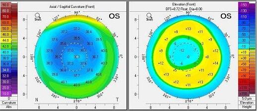 Ű׼ӼĤҽιΪӡԶӡɢⲻҪƾ֤ڹŰ׼ӼĤ׼ӼԽĤ(PRK)ΪĽĤԼ׼ӼԭλĤĥ(LASIK)ΪĽĤ.jpg