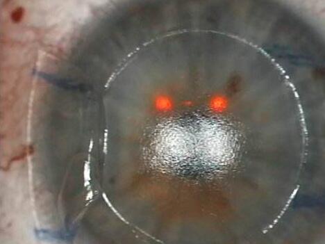 ĤͼָĸԻĤɽɽĤĤPRKƤ׼ӼĤ(Trans-PRK)Ҵ׼ӼƤ½Ĥĥ(LASEK);ҲɽɽĤLASIK뼤⸨LASIK2.jpg